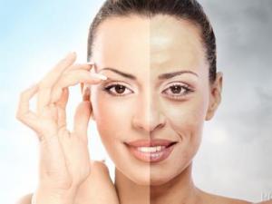 如何治療各種色斑？各類色斑的治療方法