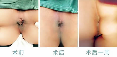 女性痔瘡真人實拍圖片 網(wǎng)上曝光的7個小偏方有效治痔瘡 女性痔瘡真人實拍圖片:網(wǎng)上曝光的7個小偏方有效治痔瘡