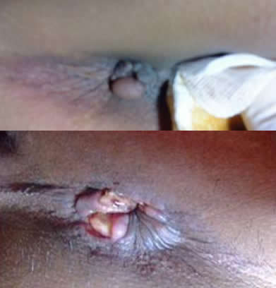 女性痔瘡真人實拍圖片 網(wǎng)上曝光的7個小偏方有效治痔瘡 女性痔瘡真人實拍圖片:網(wǎng)上曝光的7個小偏方有效治痔瘡