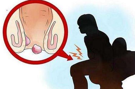 女性痔瘡真人實拍圖片 網(wǎng)上曝光的7個小偏方有效治痔瘡