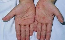 學生手掌出現紅點別大意