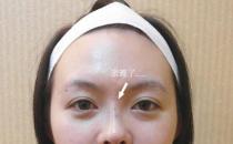 玻尿酸隆鼻維持時間