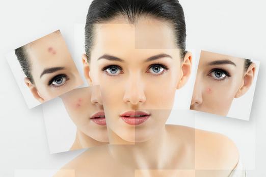 抗痘有良方 7種天然方法教你健康祛痘