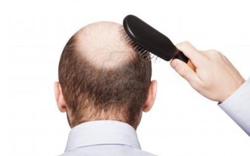 男性禿頂隱藏六信號(hào)