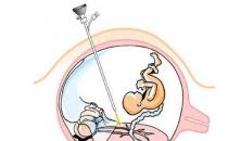 孕媽勿盲目做胎鏡檢查 操作不當可引發胎兒死亡