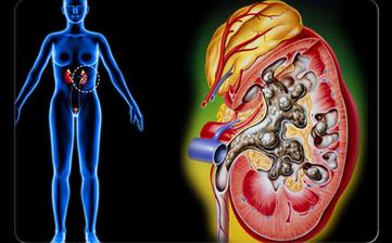 【腎結石】腎結石是怎么形成的_腎結石癥狀_腎結石治療方法_腎結石偏方