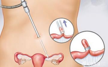 【女性結扎】女性結扎手術_結扎手術對女性的影響_女性結扎注意什么