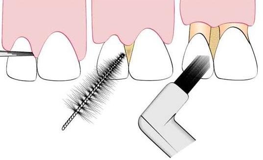 牙齦出血怎么回事？該如何預防牙齦出血