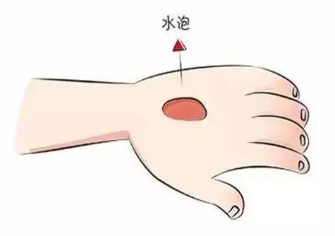 燙傷的水泡能挑破嗎 科學處置燒燙傷方法