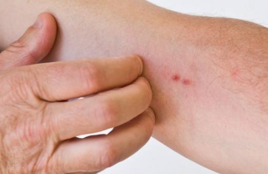 女性保健注意 女性私處易患這4種皮膚病