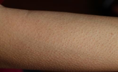 小疙瘩永遠揮之不去的困擾 讓皮膚恢復光滑！