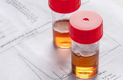 尿液渾濁的原因 教你判斷尿液是否渾濁 