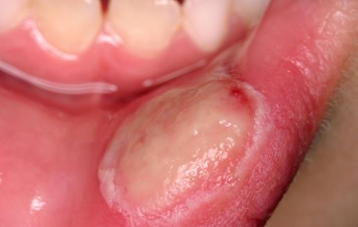 口腔潰瘍反復要從日常飲食入手 預防口腔潰瘍的方法 