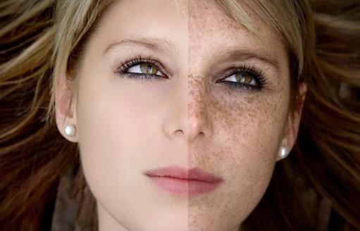 女人臉上斑點產生的原因以及消除方法