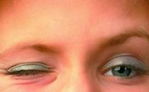 眼皮跳可能是身體出了問題 病理性眼皮跳一定要當心
