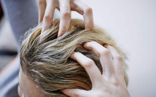 頭屑很嚴重滿頭都是怎么辦？4個好方法幫你來應對