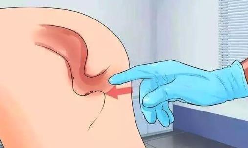 肛門潮濕是怎么回事？主要是這6大誘因在作怪