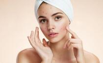 對祛痘有輔助作用的食物推薦 正確的日常護理很重要