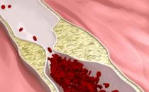 臉色發(fā)紅是血脂堵塞了血管 血脂過(guò)高的人常有的表現(xiàn)