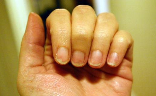 指甲上有豎紋是怎么回事?是好還是壞?聽聽專家怎么說