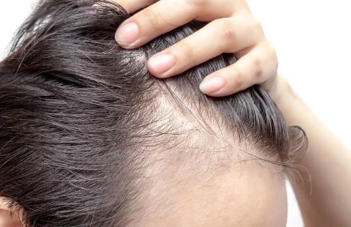 防止掉頭發除了食療還要做到這幾點