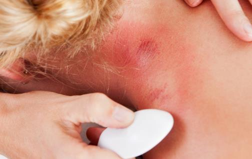 刮痧能治療哪些病 刮后注意保暖