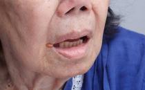 精神壓力大易導致口腔潰瘍 中醫偏方可治療口腔潰瘍