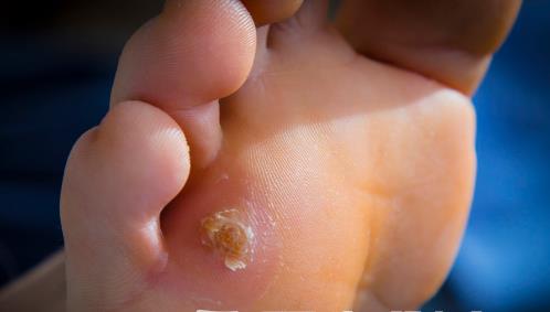 腳下出現(xiàn)老繭比較嚴(yán)重怎