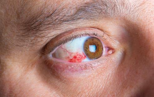 眼睛紅血絲過多