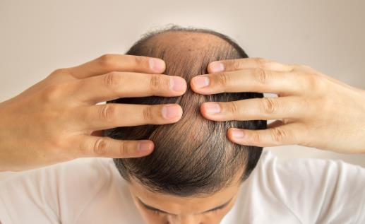 改善脫發(fā)是場持久戰(zhàn) 解決長期脫發(fā)問題有妙招