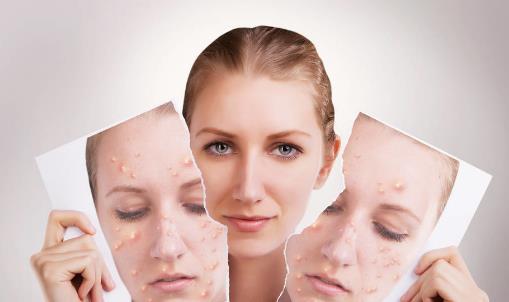 預防青春痘的4個方法