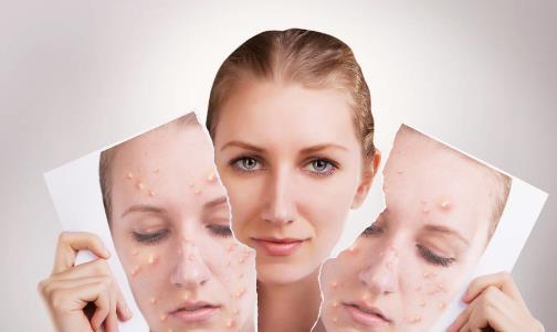 辣椒無辜背鍋！營養學專家說，長痘的“真兇”是這三種食