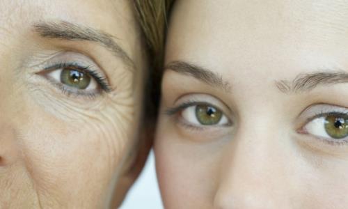 經常笑容易長眼尾紋嗎 魚尾紋該如何去除