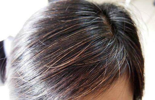 少年出現白頭發的主要原因 改善少年白的中醫技巧