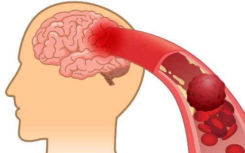 防中風控制好六大因素