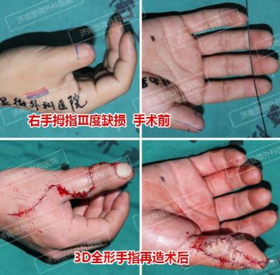 濟南顯微外科醫院 黃威手指再造怎么樣 有真實的手術案例嗎