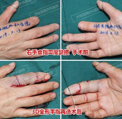 濟南顯微外科醫院 黃威手指再造怎么樣 有真實的手術案例嗎