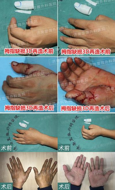 濟南顯微外科醫院 黃威手指再造怎么樣 有真實的手術案例嗎