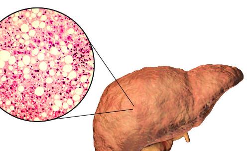 脂肪肝患者飲食禁忌有哪些 預(yù)防脂肪肝的食物要多吃