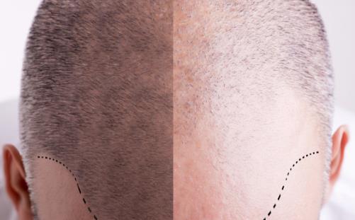 當(dāng)代壓力大脫發(fā)的人越來(lái)越多 冬日防禿的日常妙招