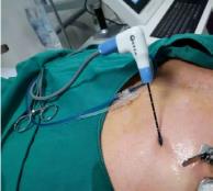 深圳腫瘤醫院請選擇廣州復大腫瘤醫院:微波消融保肝抗癌