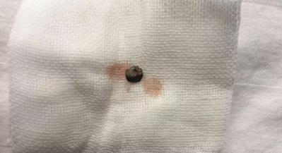 普瑞眼科取出患者眼內(nèi)5毫米金屬，保住眼球