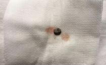 普瑞眼科取出患者眼內(nèi)5毫米金屬，保住眼球