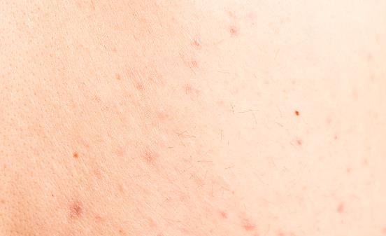 為什么后背容易長(zhǎng)痘 可使你背部的痘痘消散