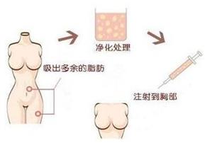 煤醫整形：自體脂肪豐胸的四大優勢