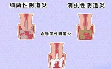 【霉菌性陰道炎】霉菌性陰道炎的治療_霉菌性陰道炎的癥狀_霉菌性陰炎怎么引起的 【霉菌性陰道炎】霉菌性陰道炎的治療_霉菌性陰道炎的癥狀_霉菌性陰炎怎么引起的