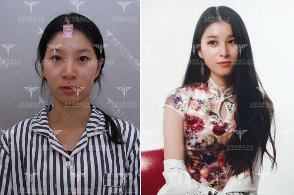 北京潤美玉之光張紅芳丨自體脂肪精度填充，在細節上提升效果