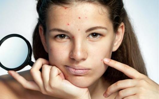 祛痘印小竅門學起來 讓女性顏值隨時在線