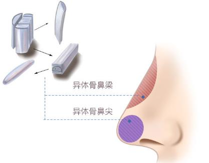 北京圣慈整形醫(yī)院鼻子王王軍怎么樣?專(zhuān)業(yè)實(shí)力 讓你放心美