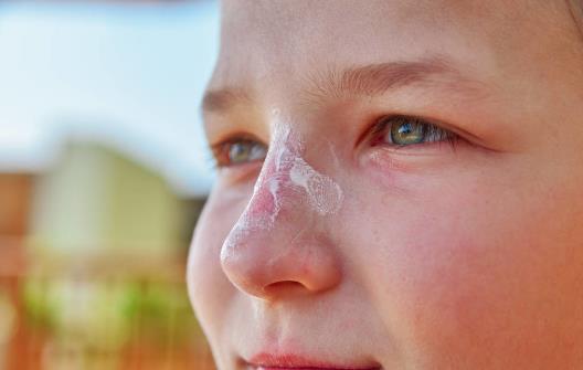 鼻子老是紅紅的怎么辦